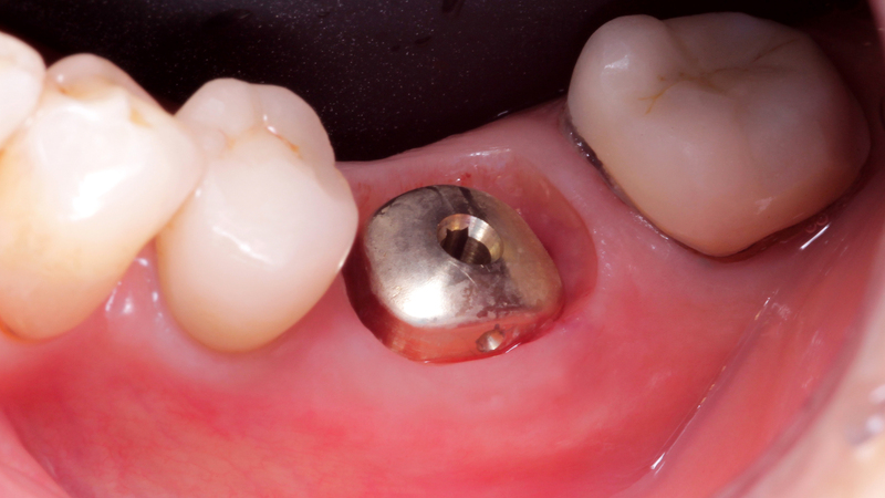 iPhysio implantát in situ 1