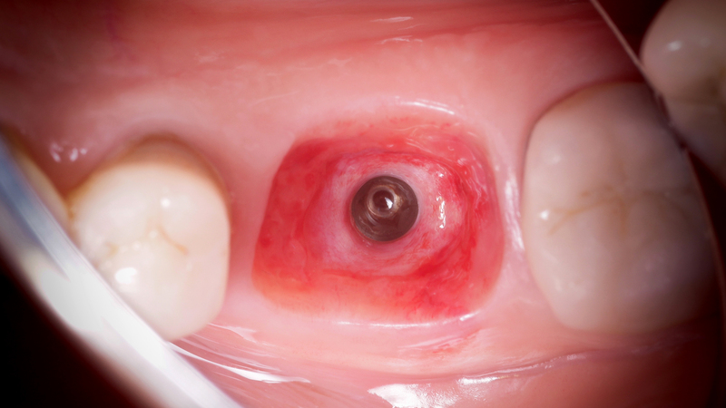 iPhysio implantát in situ 2