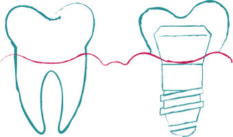 Šrouby pro implantáty